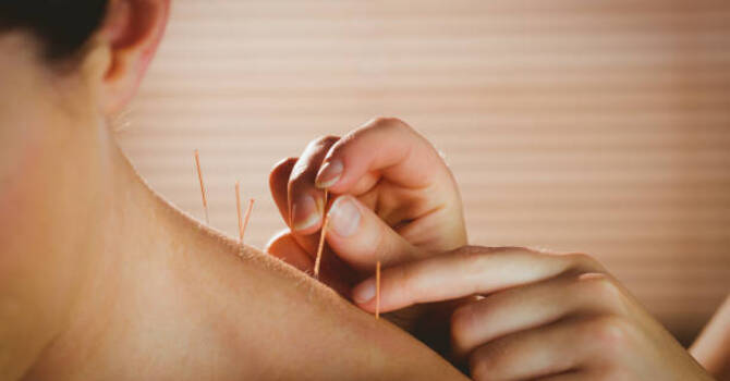 Acupuncture and Electroacupuncture